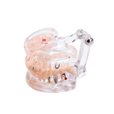 32 Diente Mes completo Enfermedad de implantes Modelo de dientes Diseño claro Modelo de patología dental