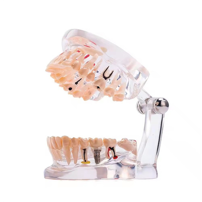 32 Diente Mes completo Enfermedad de implantes Modelo de dientes Diseño claro Modelo de patología dental